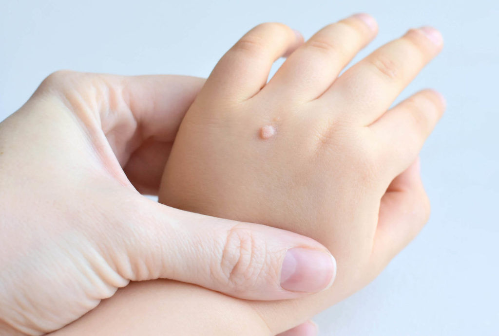 Dr Lisa Chan on How to Deal With Warts and Avoid Them Completely