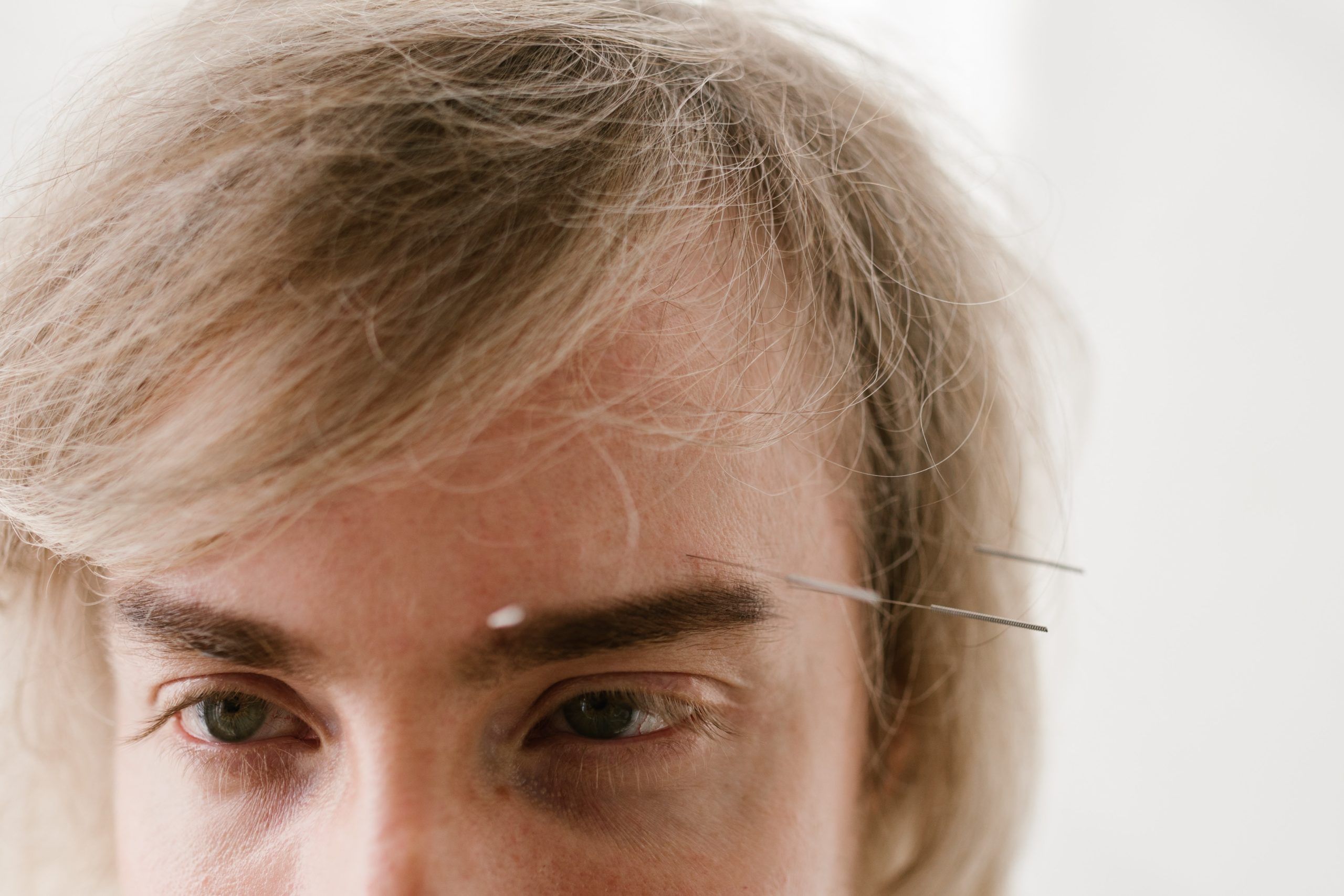 spa treatment- acupuncture