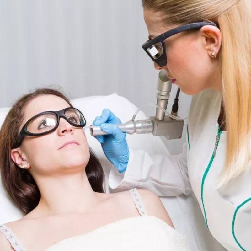 What to know before getting melasma laser treatment