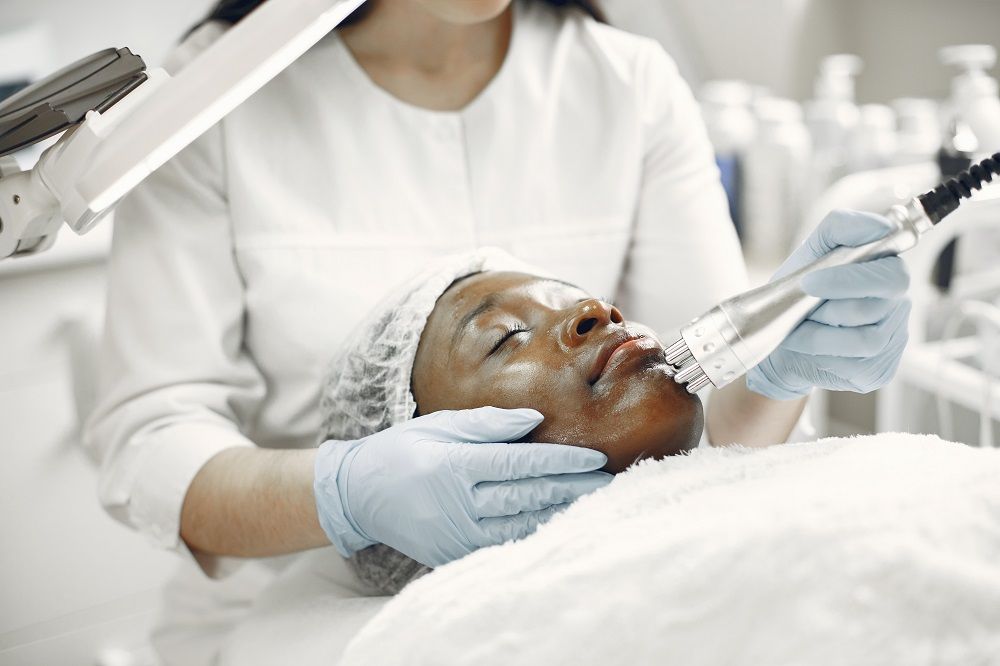 melasma laser treatment
