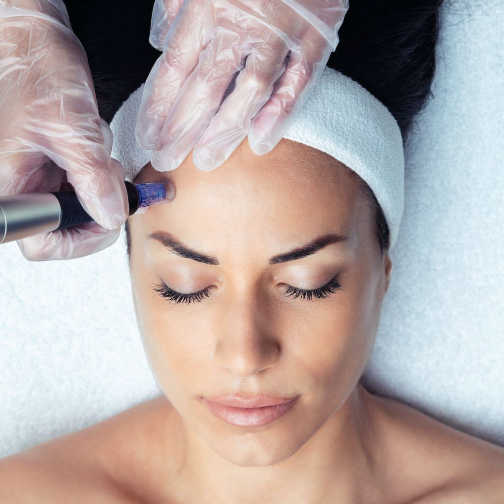 Is microneedling capable of bidding your acne scars a permanent adieu? Let’s find out!
